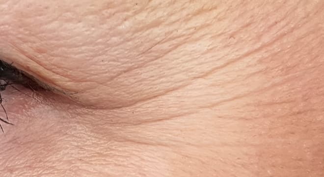 小じわ