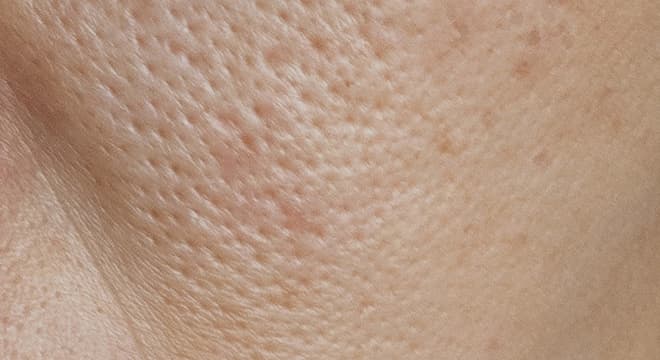 毛穴の開き