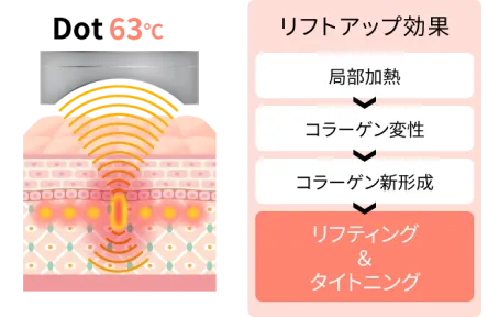 HIFU(ドット)