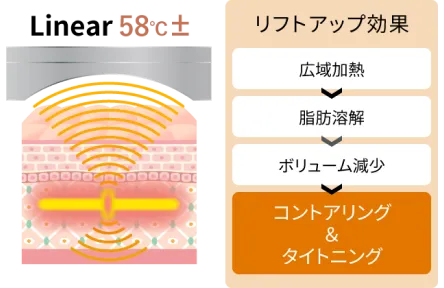 HIFU(リニアファーム)